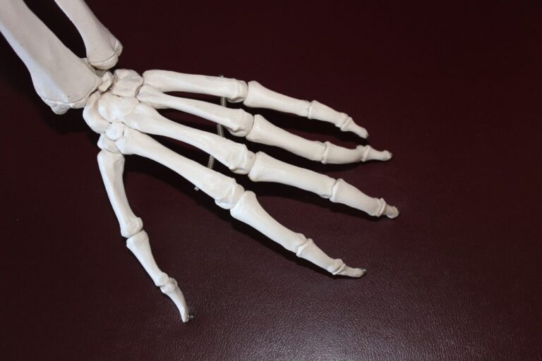 Artrosis de la mano